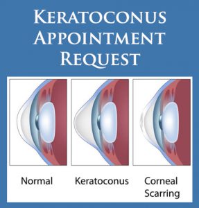 Stages of Keratoconus