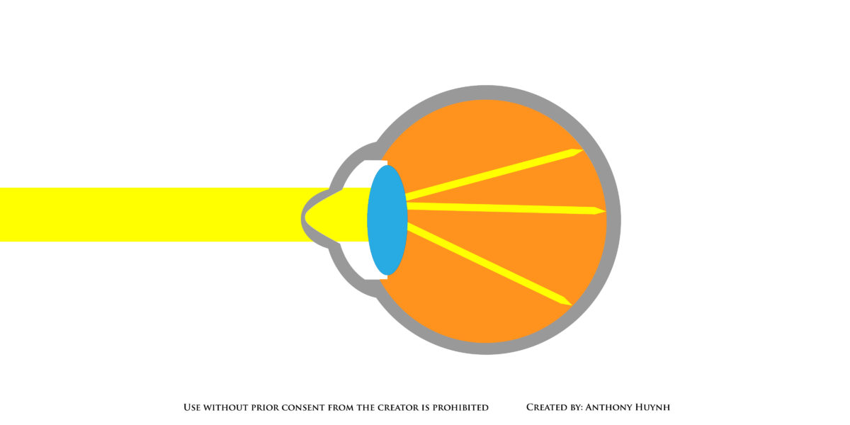 Keratoconus light diagram