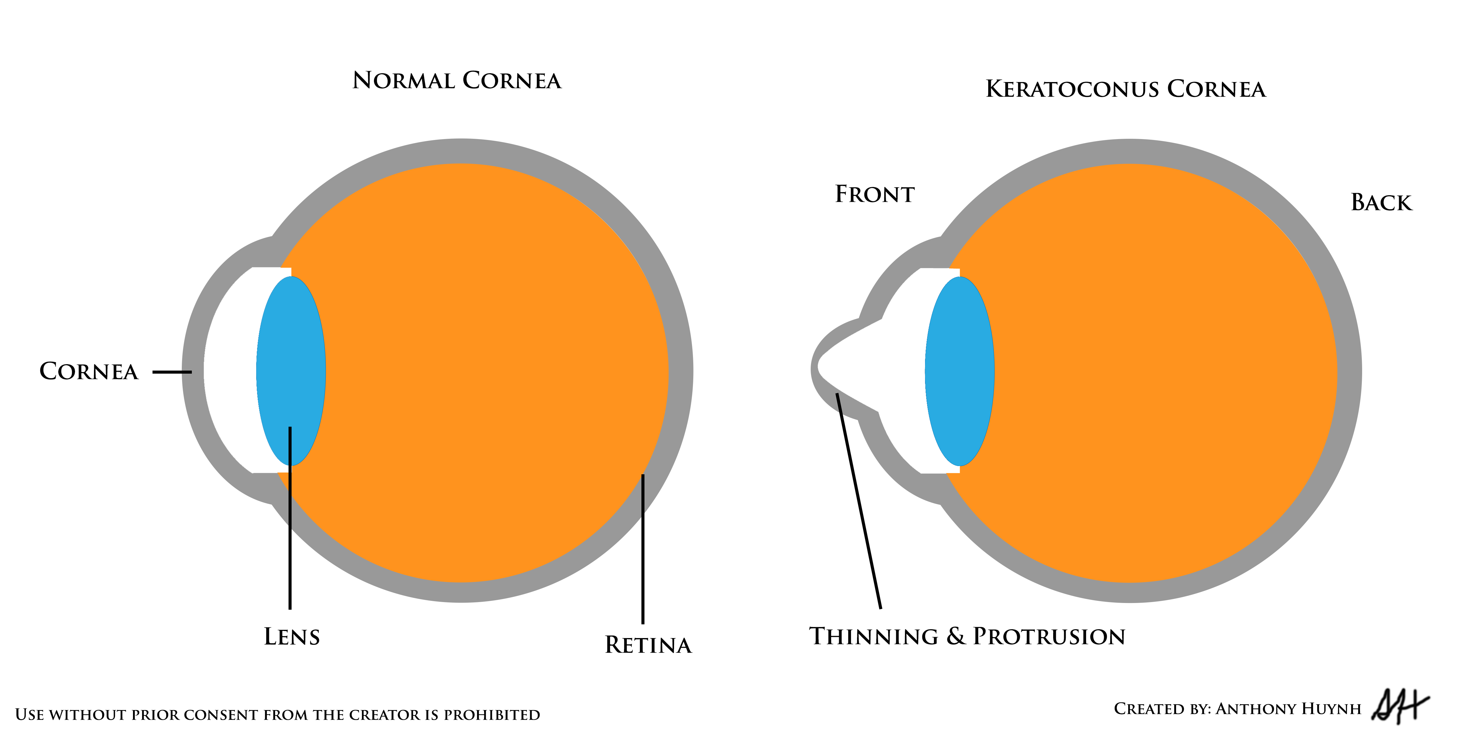 Keratoconus Diagram