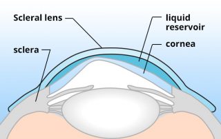 Scleral Lens Design