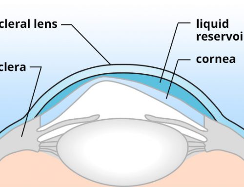 Custom Contact Lenses